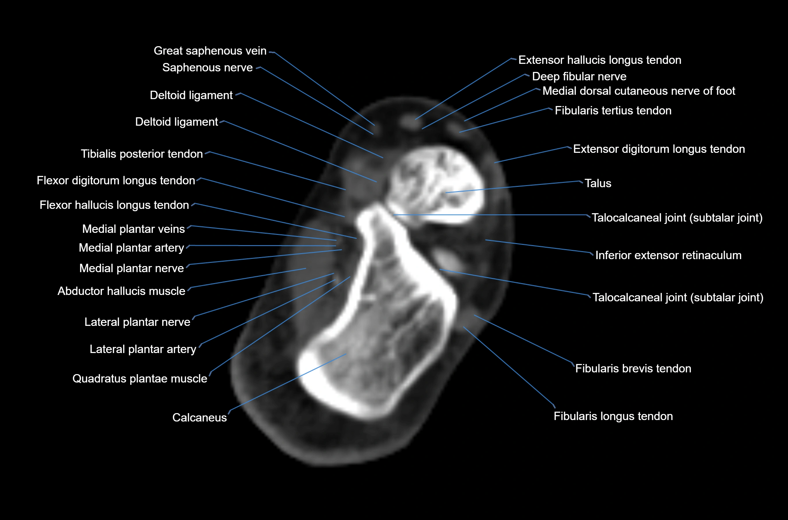 CT Ankle axial cross sectional anatomy labelled image -00039.webp